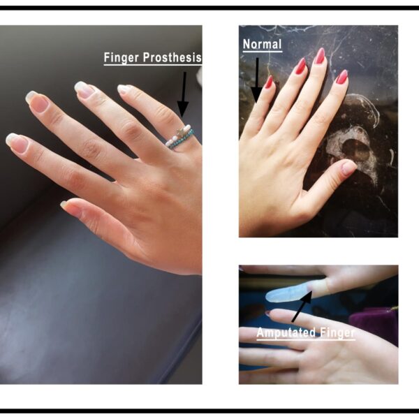 Finger and Partial Hand  Amputees